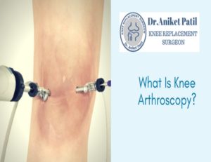 Dr. Aniket patil-knee replacement surgeon