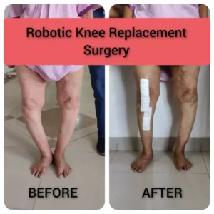 robotic-knee-replacement-surgery-patients-dr-aniket-patil-om-hip-and-knee-speciality-orthopedic-and-physiotherapy-clinic-pune-pcmc