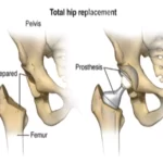 Hip replacement